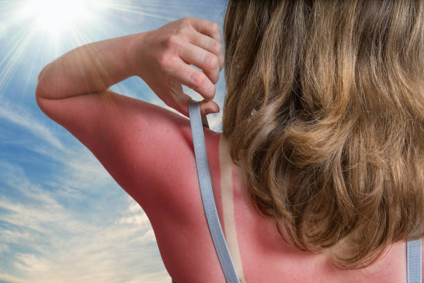 istock Sunburn concept. Young woman with red sunburned skin on her back. 953432980