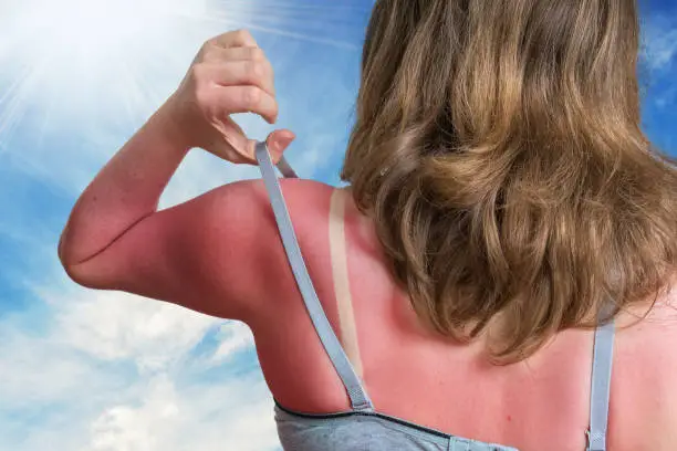 Sunburn concept. Young woman with red sunburned skin on her back.