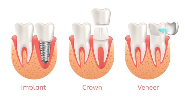 ilustraciones, imágenes clip art, dibujos animados e iconos de stock de restauración con corona dientes procedimiento implante de carillas - corona-dental
