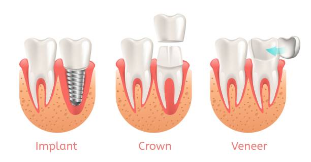 illustrations, cliparts, dessins animés et icônes de procédure de dents implant placage couronne restauration - couronne dentaire