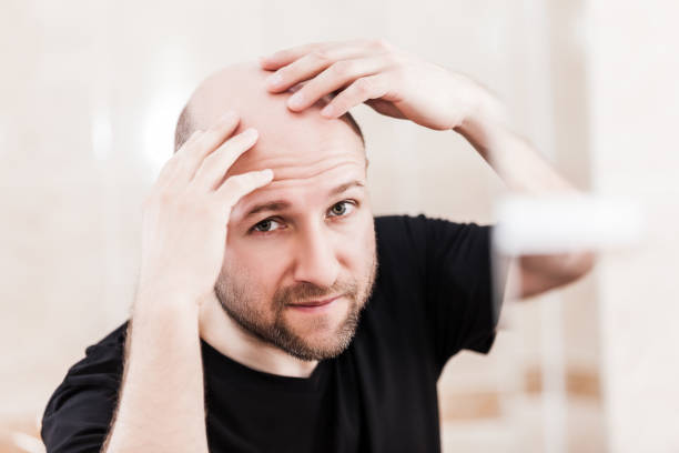 Bald man looking mirror at head baldness and hair loss stock photo