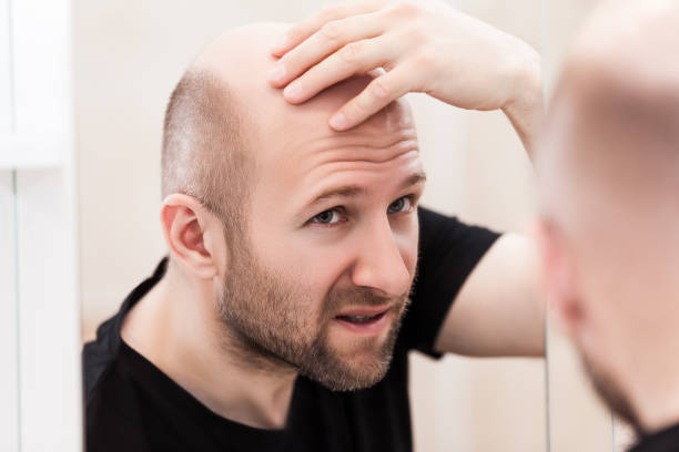 Bald man looking mirror at head baldness and hair loss Male alopecia or hair loss concept - adult caucasian bald man looking mirror for head baldness treatment balding photos stock pictures, royalty-free photos & images