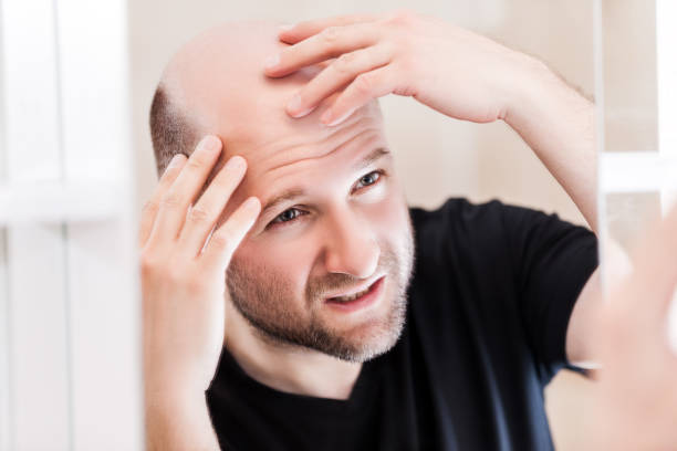 istock Bald man looking mirror at head baldness and hair loss 953668912