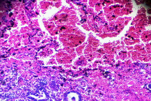 현미경 검사 법에서 간 질 성 pneumonitis 인간의 병 리 샘플 - interstitial 뉴스 사진 이미지