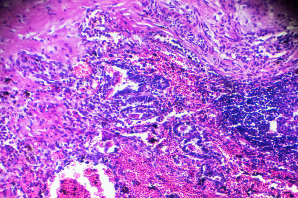 현미경 검사 법에서 간 질 성 pneumonitis 인간의 병 리 샘플 - interstitial 뉴스 사진 이미지