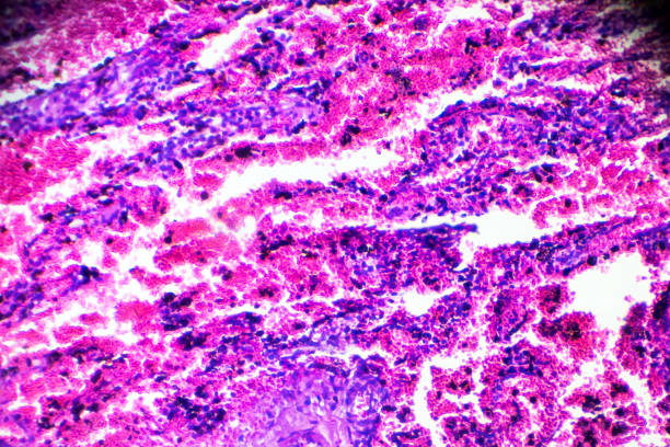 muestra de patología humana de neumonitis intersticial bajo microscopia - interstitial fotografías e imágenes de stock