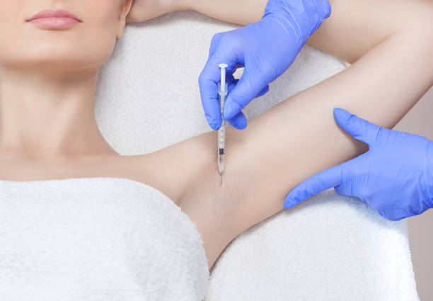 The doctor makes intramuscular injections of botulinum toxin in the underarm area against hyperhidrosis The doctor makes intramuscular injections of botulinum toxin in the underarm area against hyperhidrosis. sweat gland stock pictures, royalty-free photos & images