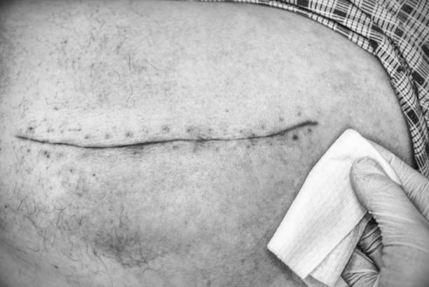 altes menschliches bein mit postoperativen narbe der hüftgelenk-chirurgie. selektiven fokus des männlichen körpers. - pacemaker torso chest male stock-fotos und bilder