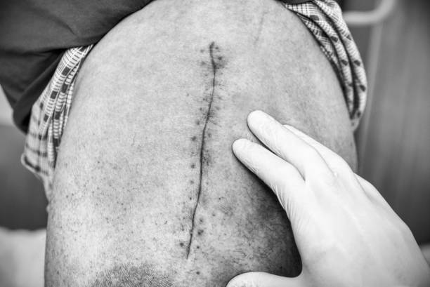 altes menschliches bein mit postoperativen narbe der hüftgelenk-chirurgie. selektiven fokus des männlichen körpers. - pacemaker torso chest male stock-fotos und bilder