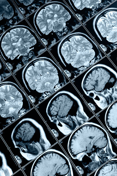 MRI the brain X-ray  x ray results stock pictures, royalty-free photos & images