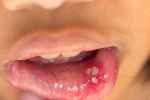 istock mouth ulcer or canker sore or aphthous stomatitis or  aphthous ulcer 954260344