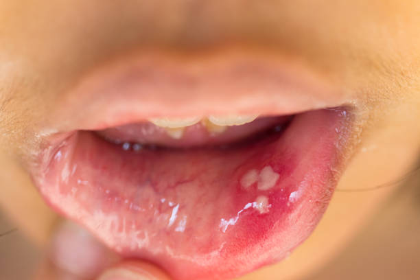 mouth ulcer or canker sore or aphthous stomatitis or  aphthous ulcer - 600 imagens e fotografias de stock