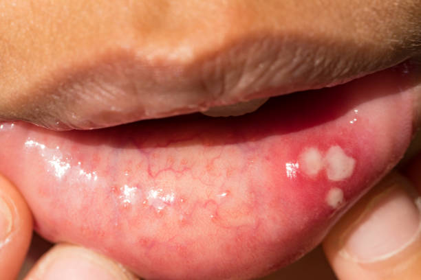 istock mouth ulcer or canker sore or aphthous stomatitis or  aphthous ulcer 954260426