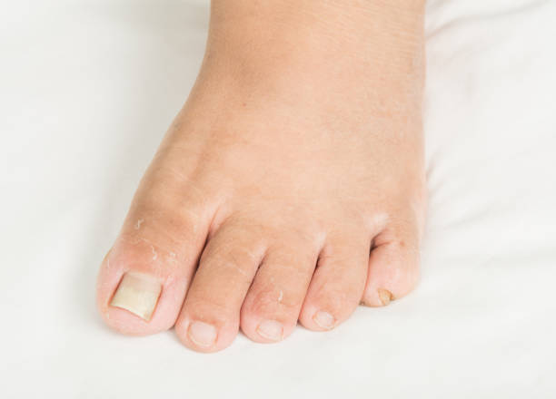 istock Fungus on the toenail And dermatitis 954497384
