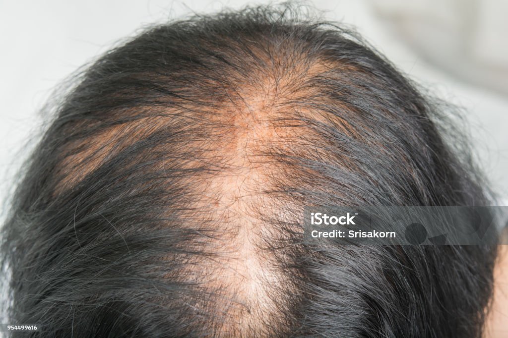 Thin Hair And Scalp And Broken Hair Stock Photo - Download Image Now - Hair,  Human Scalp, Women - iStock