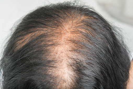 Thin Hair And Scalp And Broken Hair Stock Photo - Download Image Now - Hair, Human Scalp, Women - iStock Thin Hair And Scalp And Broken Hair Stock Photo - Download Image Now - Hair, Human Scalp, Women - iStock