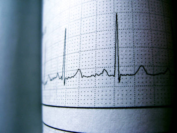 Sinus Heart Rhythm On Electrocardiogram Record PaperShowing Normal P Wave