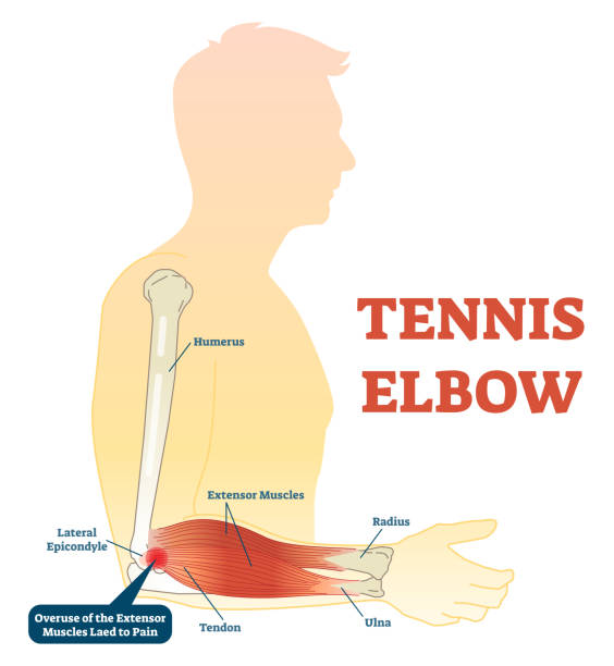 ilustrações de stock, clip art, desenhos animados e ícones de tennis elbow medical fitness anatomy vector illustration diagram with arm bones, joint and muscles. - elbow