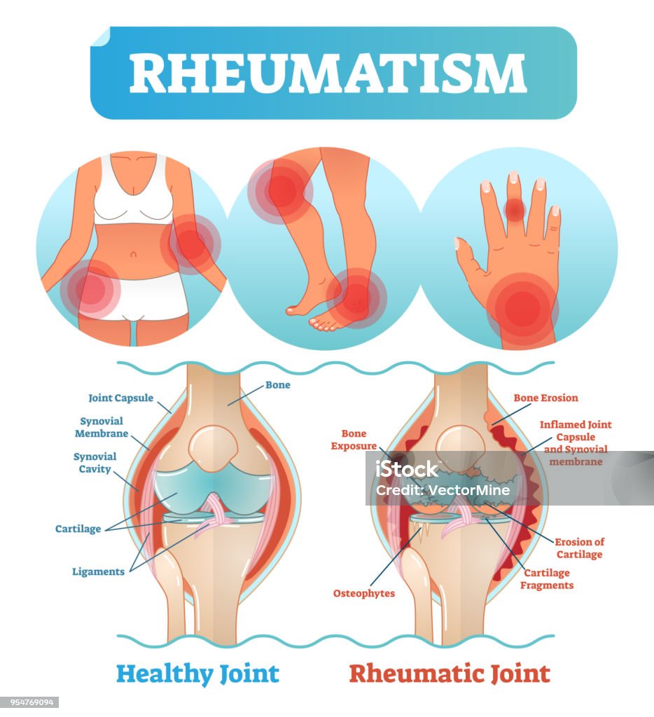 Rheumatism medical health care vector illustration poster diagram with damaged knee erosion and painful body joints. Rheumatism medical health care vector illustration poster diagram with damaged knee erosion and painful body joints. Healthy knee joint comparison to rheumatic one. Anatomical scheme. Joint - Body Part stock vector