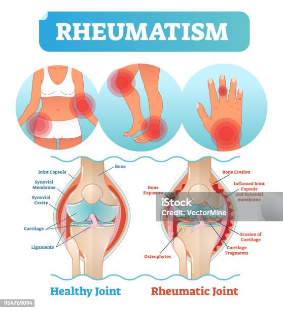Rheumatism Medical Health Care Vector Illustration Poster Diagram With Damaged Knee Erosion And Painful Body Joints Stock Illustration - Download Image Now