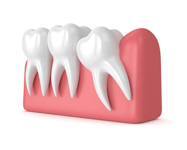 istock 3d render of teeth with wisdom mesial impaction 954778532
