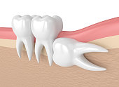 3d render of teeth with wisdom horizontal impaction