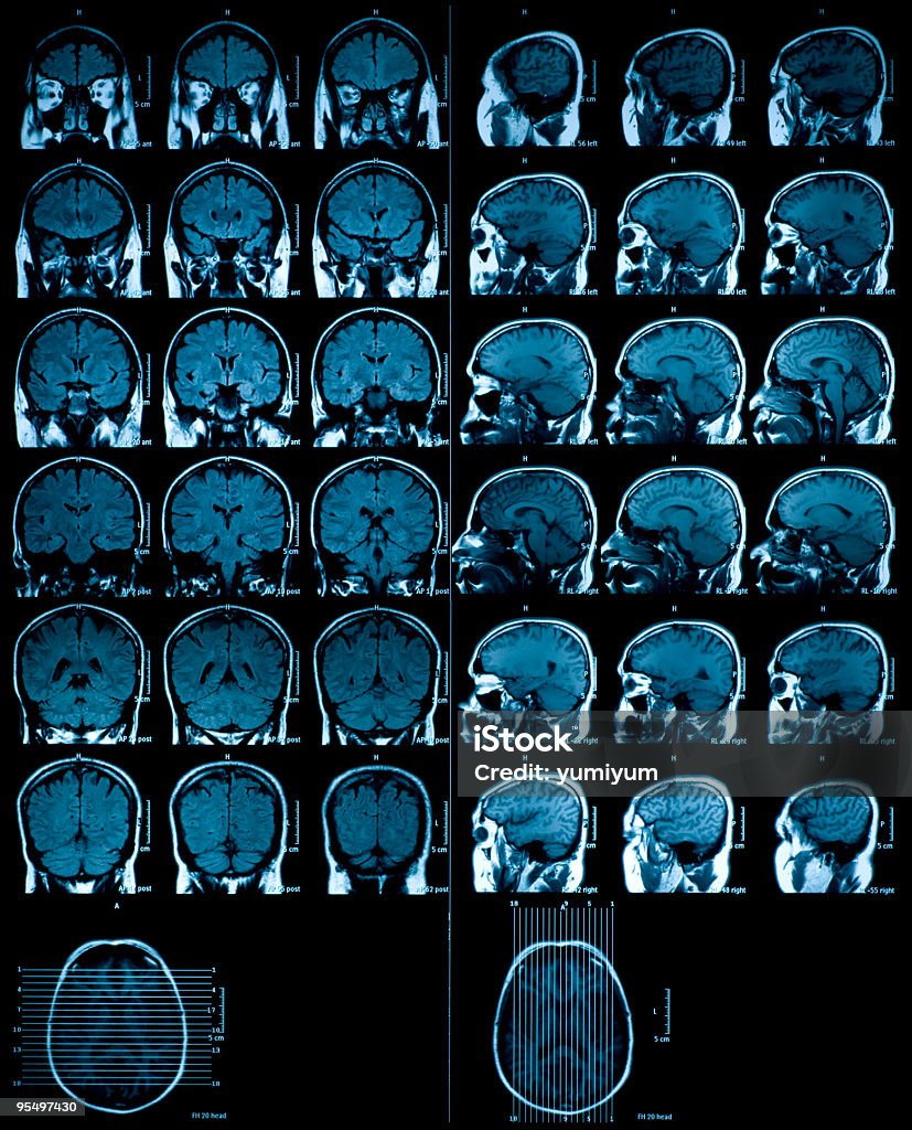 MRI scan des Gehirns - Lizenzfrei Anatomie Stock-Foto