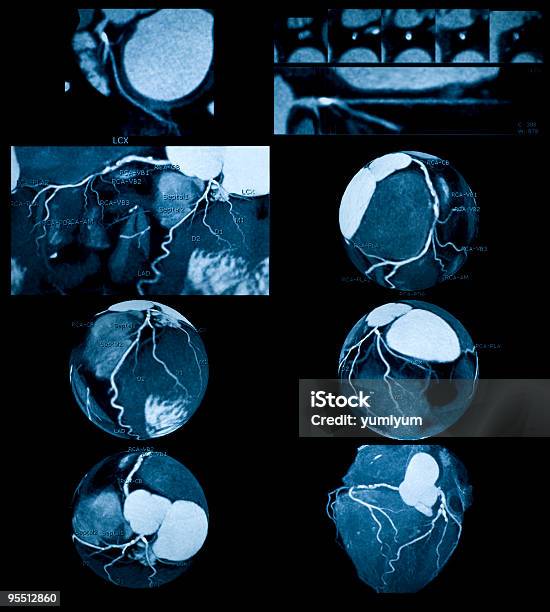 Angiografía Coronaria Foto de stock y más banco de imágenes de Tomografía axial computerizada - Tomografía axial computerizada, Anatomía, Arteria coronaria