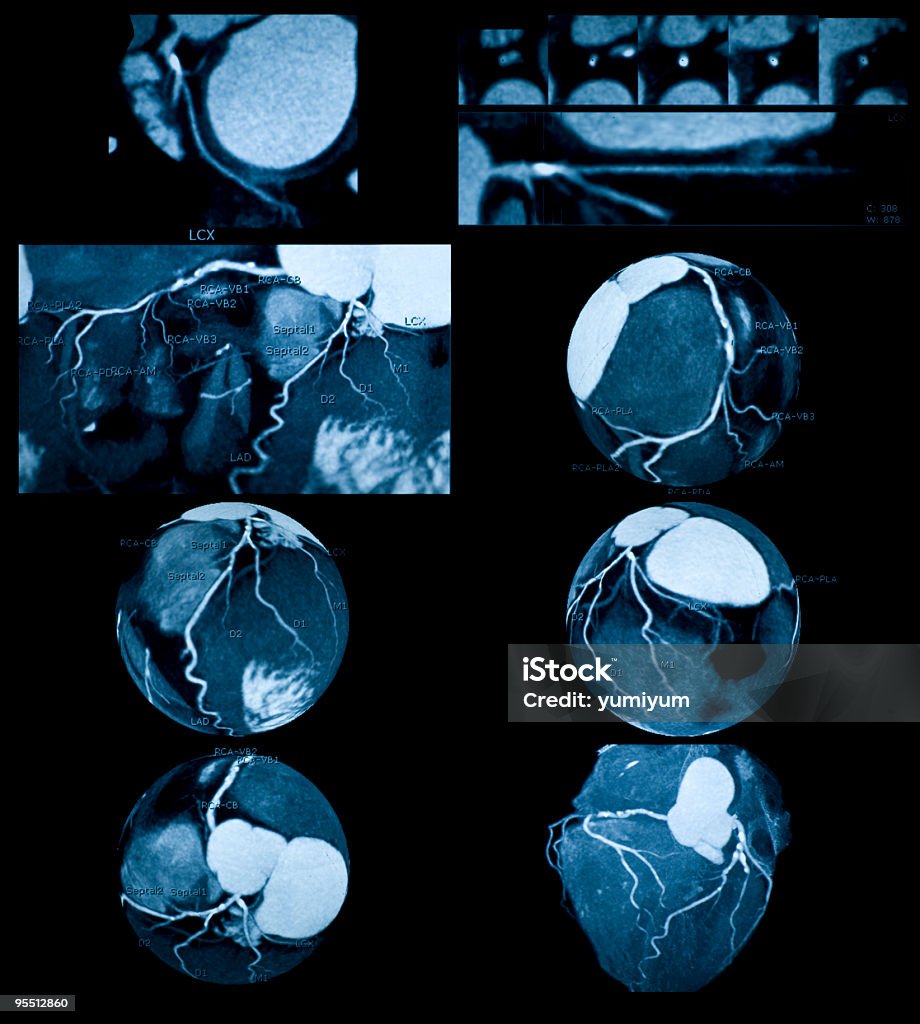 冠動脈造影 - CTのロイヤリティフリーストックフォト