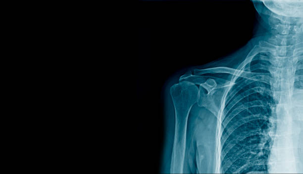 istock shoulder x-ray banner in blue tone, hight quality human shoulder with space for text 955273918