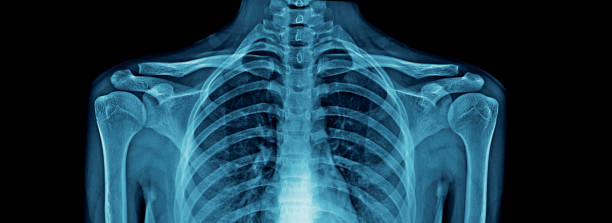 upper part of human body x-ray, high quality chest x-ray and part of spine and full ap of shoulder joint in blue tone for webpage, banner - human upper body xray imagens e fotografias de stock