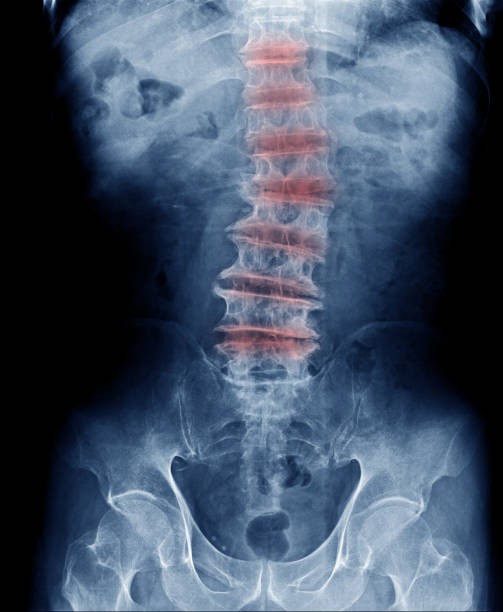 thoracic and lumbar degenerative change x-ray image, back pain in old man show x-ray image of spondylosis, spur loss of disc space and scoliosis multiple level stock photo