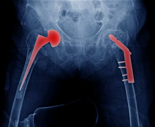 istock high quality x-ray hip replacement in old man, degenerative change of hip and post operation femur head fixation, bilateral hip replacement and fixation of head of femur 955274038