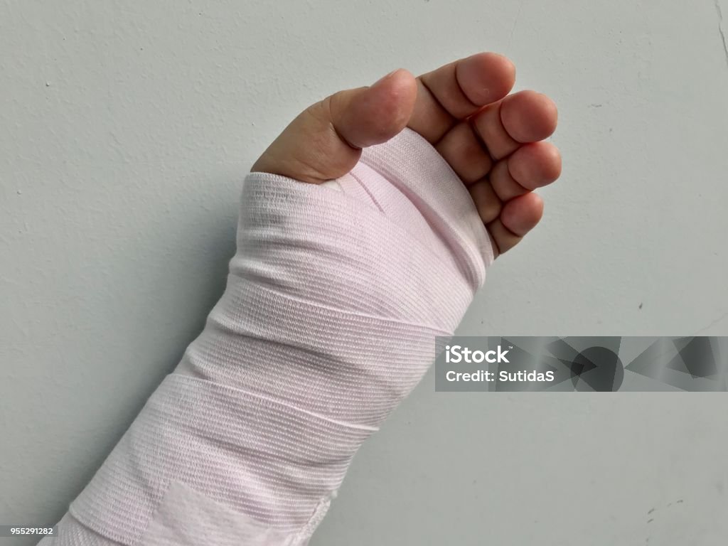 Broken Hand Injury Hand And Wrist Splinting Stock Photo - Download Image  Now - Accidents and Disasters, Arm, Assistance - iStock