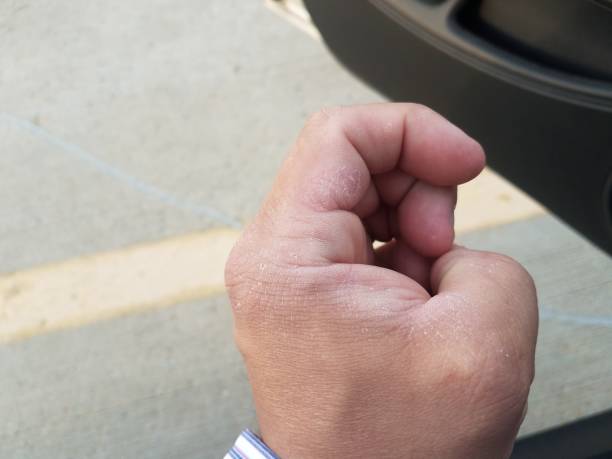 istock man's dry skin on hand and car door 955603398