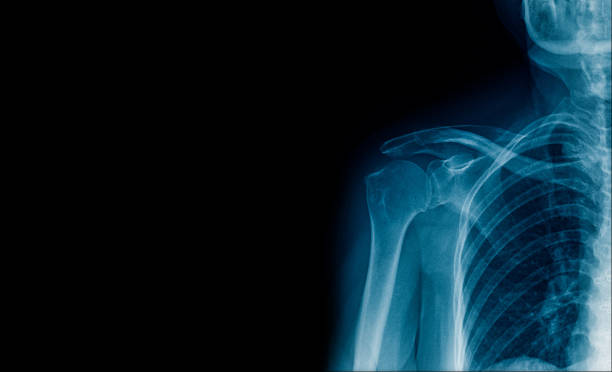 istock x-ray image shoulder single side, high quality x-ray shoulder banner or space for text 955723780