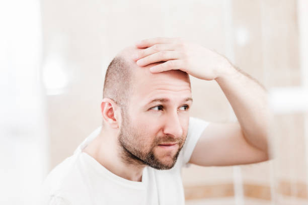 istock Bald man looking mirror at head baldness and hair loss 955998402