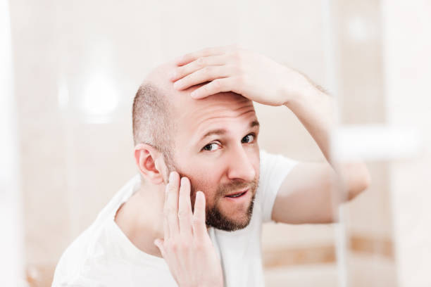 istock Bald man looking mirror at head baldness and hair loss 955998420