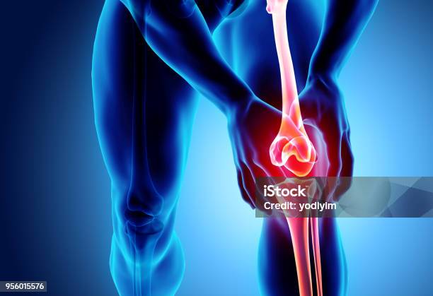 무릎 통증을스켈레톤 X선 무릎에 대한 스톡 사진 및 기타 이미지 - 무릎, 아픔, 관절