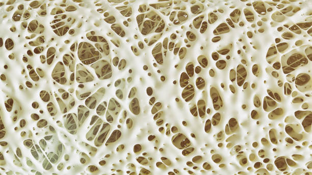 istock Osteoporosis advanced -high details - Stage 4 - 3d rendering 956021274
