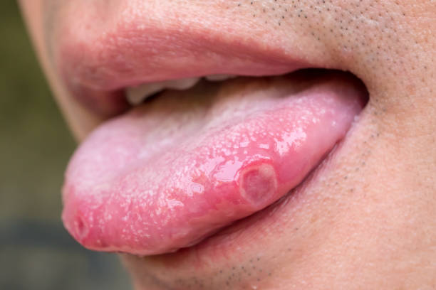 la langue avec ulcères d’homme adulte - bouche humaine photos et images de collection
