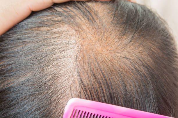 istock Thin  hair and scalp  and broken hair 956292082