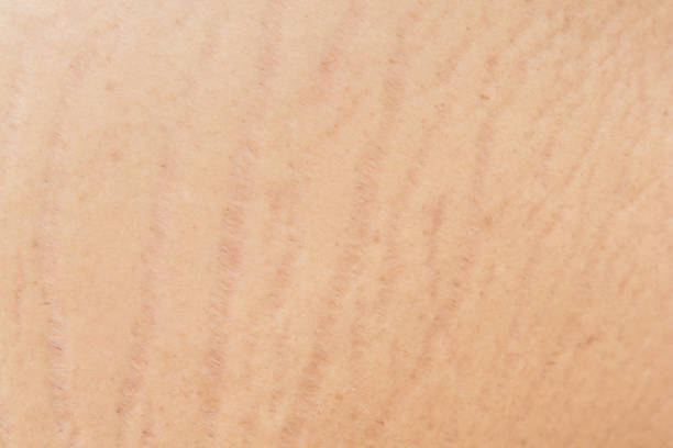 istock Stretch marks on the skin, wrinkles 956301736