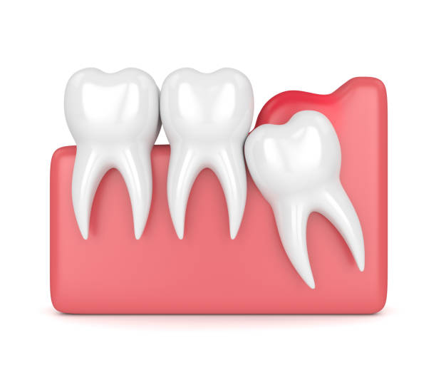 istock 3d render of  wisdom mesial impaction with pericoronitis 956334614