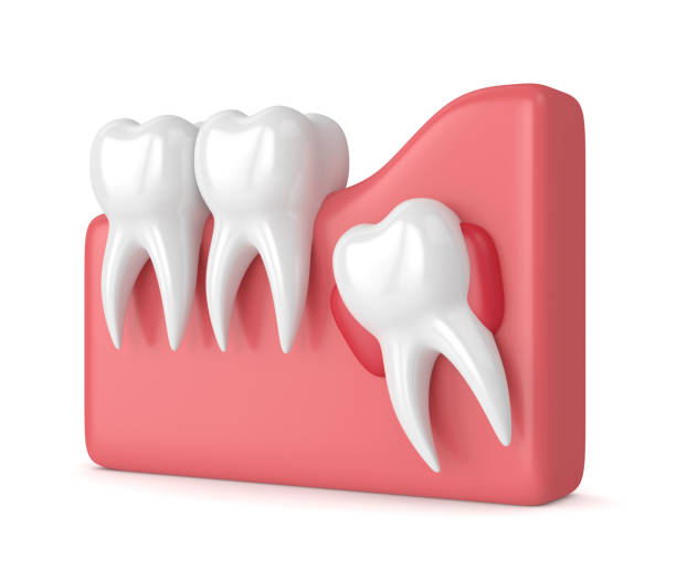 istock 3d render of teeth with wisdom cyst 956334968