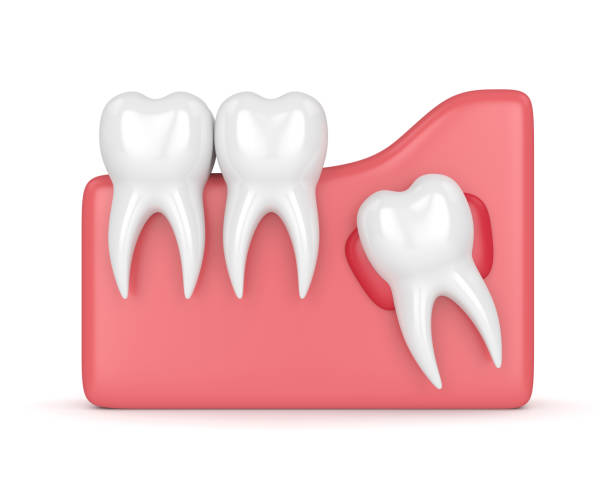 istock 3d render of teeth with wisdom cyst 956335748
