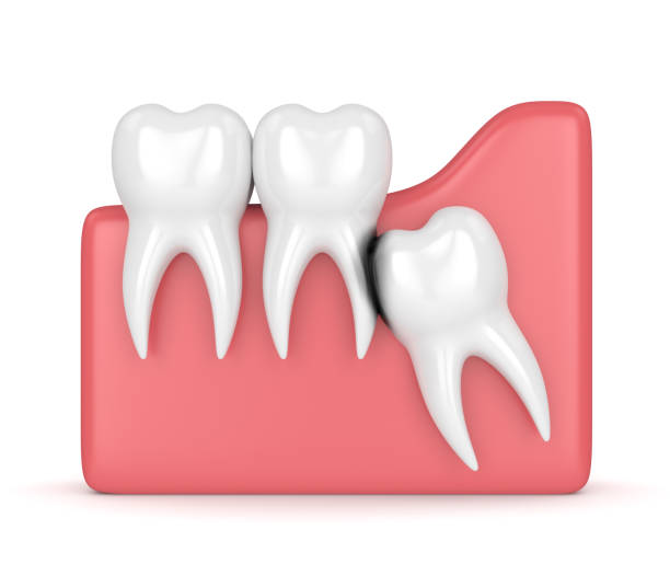 istock 3d render of wisdom with erosion cavity 956340138