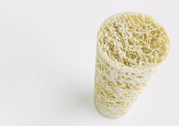 istock Cross section of an advanced osteoporosis -high details - Stage 4 - 3d rendering 956791712