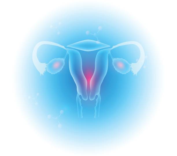 női reproduktív szervek - policisztás ovárium szindróma témájú stock illusztrációk