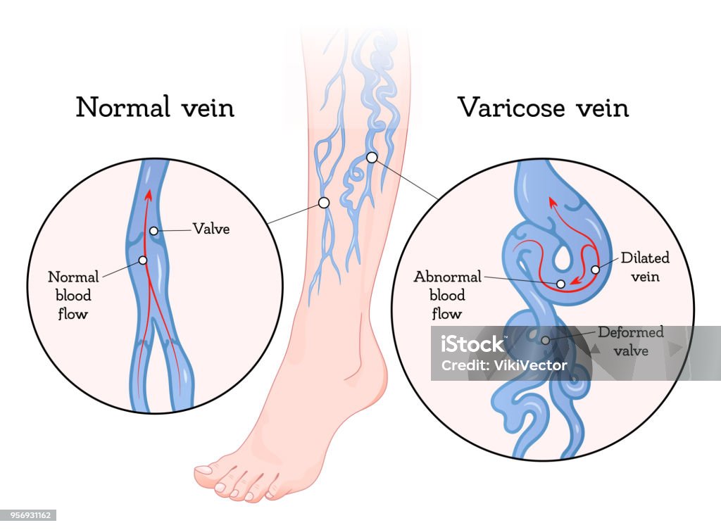 Varicose Veins Poster Stock Illustration - Download Image Now - Varicose  Vein, Vein, Leg - iStock